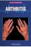 Arthritis